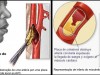 Infarto do Miocárdio – O que é e Primeiros Socorros em Caso de Infarto