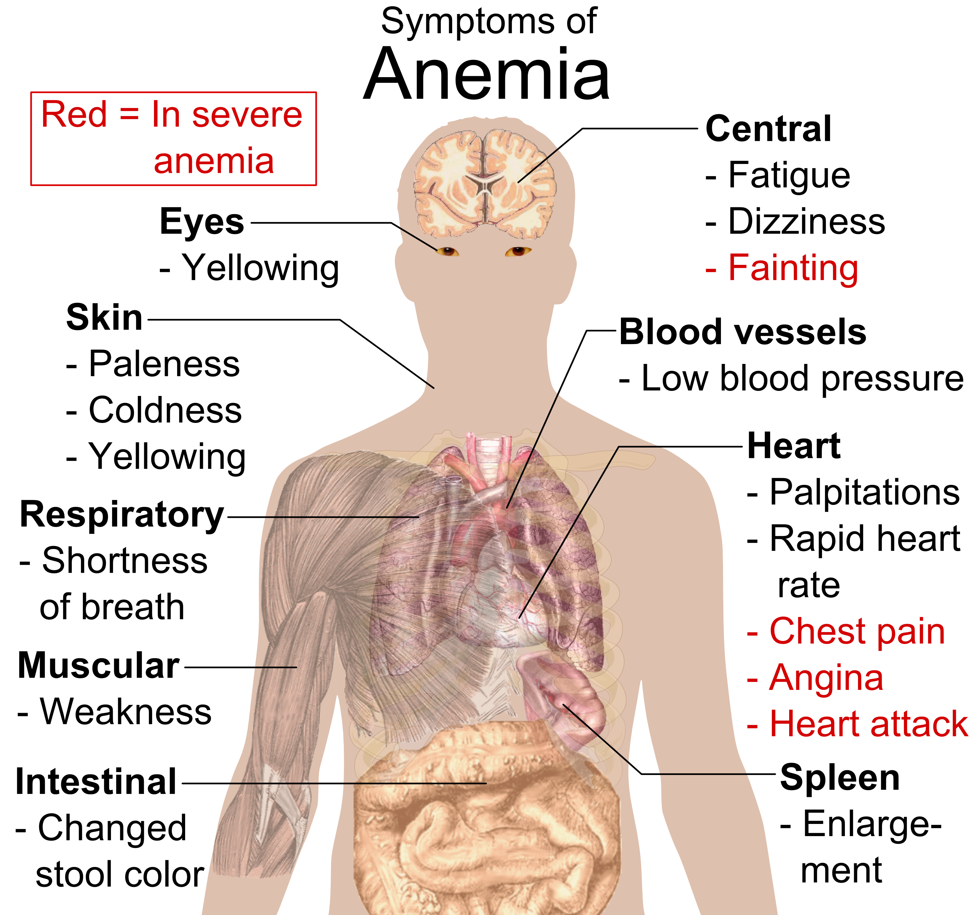 Anemia Principais Tipos Caracter sticas Sinais E Sintomas