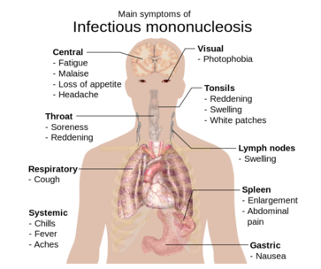 Sintomas da Mononucleose Infecciosa