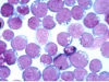 Mononucleose Infecciosa – Patogênese, Manifestações Clínicas e Tratamento