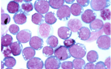 Mononucleose Infecciosa – Patogênese, Manifestações Clínicas e Tratamento