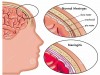 Meningites Bacterianas – Patologia, Sintomas e Diagnóstico da Doença