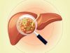 Hepatites  Crônicas – Quadro Clínico e Diagnóstico
